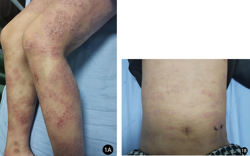 Figure 1 (A and B) Typical AD lesions on both lower extremities and trunk.