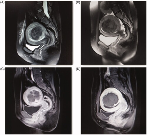 Figure 2. Pre- and post-HIFU MRI images obtained from a patient with type II uterine fibroid. (A) Before HIFU treatment, the endometrium was intact and continuous. (B) After HIFU treatment, the endometrium remained intact and continuous without damage. (C) Before HIFU treatment, the contrast-enhanced MRI image showed heterogeneous enhancement within the fibroid with blood perfusion. (D) After HIFU treatment, the contrast-enhanced MRI image only marginal enhancement of uterine fibroid, indicating that there was no blood perfusion inside the fibroid.
