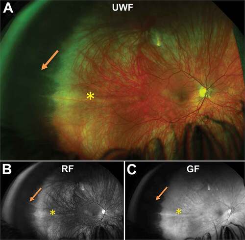 Figure 2. Dentate processes (arrow) visible in the temporal peripheral retina of a 31 year old Caucasian female using (A) UWF imaging, and separated as the (B) red-free image and (C) green-free image. A meridional fold is also present (asterisk). Abbreviations: UWF, ultra-widefield; RF, red-free; GF, green-free.