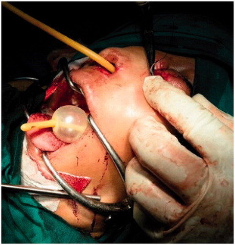 Figure 6. Suturing of the external skin defect and nasal packing over the balloon of Foley’s catheter.