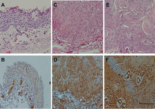 Figure 1 (A–F) H&E versus Immunohistochemistry stainings for interleukin-6 in samples of OSSN and conjunctival tissue. (A, B): Non-neoplastic conjunctiva; (C, D): Conjunctival intraepithelial neoplasia Grade III: note the positive cytoplasmic staining; (E, F): Squamous cell carcinoma shows strong positive staining. Scale bar is 100 µ.Abbreviations: H&E, hematoxylin and eosin; OSSN, ocular surface squamous neoplasia.
