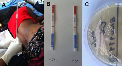 Figure 3 (A–C) Diagnosis of cryptococcal meningitis. (A) Lumbar puncture being performed on a human immunodeficiency virus-infected patient with suspected meningitis in Malawi. (B) Lateral flow immunoassay test strips for cryptococcal antigen detection (the strip on the left shows a negative result, indicated by a single horizontal “control” band in the center; the strip on the right shows a positive result, indicated by adjacent horizontal “control” and “test” bands). (C) Cryptococcus neoformans growing on Sabouraud media. Images kindly supplied by Kate Gaskell, College of Medicine, University of Malawi, and Brigitte Denis, Malawi Liverpool wellcome Trust Clinical Research Programme.