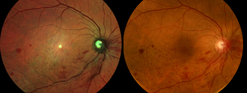 Figure 2 MFI and CFP of a patient with an inferior branch retinal vein occlusion.