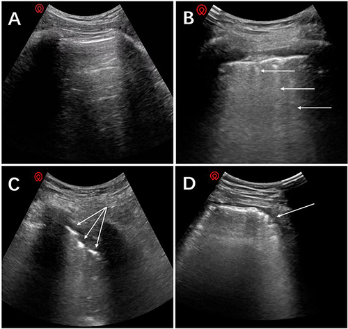 Figure 2 Lung ultrasound images with different scores. (A) Normal pattern “bat-sign” with A-lines parallel to the pleural line, score = 0; (B) ≥3 B lines arising from pleural line, score = 1; (C) Multiple subpleural consolidations separated by an irregular pleural line, score = 2; (D) Large-sized consolidation, score = 3. Arrow indicates corresponding pathologic findings of each figure.