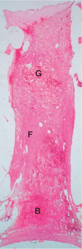 Figure 1. Example of typical bone ingrowth in a bone chamber (hematoxylin and eosin). This goat received meloxicam and a rinsed allograft was used. Nonvascular-ized remnants of the graft (G) can be seen at the top of the chamber. A fibrous ingrowth zone (F) can be seen between the graft and the newly formed bone, and a zone of newly formed bone (B) can be seen at the bottom of the chamber. Magnification 12.5x.
