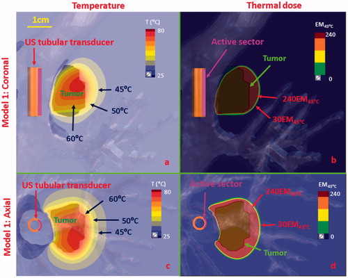 Figure 8. Temperature and thermal dose distributions of patient-specific Model 1 on the coronal (a, b) and axial plane (c, d) after 300 s sonication with an endobronchial ultrasound tubular applicator (6 mm transducer OD × 10 mm length, 10 mm balloon OD, 6 MHz, 9 W/cm2, 120° active zone), as applied to deliver thermal coagulation to the tumor (∼1 cm in depth) attached to major airways. Temperature contours of 45 °C, 50 °C, and 60 °C are shown in (a) and (c), and thermal dose contours of 30 EM43˚C and 240 EM43˚C are shown in (b) and (d). US: ultrasound.