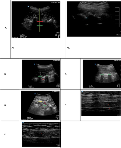 Figure 2 Sonographic approach for common regional anesthesia approaches for caesarean delivery. (A) Epidural Anesthesia. (Ai) Ultrasound of lumbar back for epidural or spinal anesthesia placement, transverse orientation. Yellow line – midline. Red line – posterior complex. Green line – anterior complex. (Aii) Ultrasound of lumbar spine for epidural or spinal anesthesia placement, sagittal orientation. Black lines – lamina. Red asterisk – approximate location of epidural space. Red line – posterior complex. Green line – anterior complex. (B) Paravertebral Block Green lines – Transverse processes. Red line – pleura. (C) Erector Spinae Plane Block Green lines – transverse processes. (D) Quadratus Lumborum Blocks. (E) Transversus Abdominis Plane Block. (F) Rectus Sheath Block. *Quadratus lumborum muscle. Yellow line – plane for lateral QL block. Red line – plane for posterior QL block. Green line – plane for anterior QL block. *Target plane for TAP block. *Target plane for rectus block superficial to the posterior rectus sheath superficially and the peritoneum deep.