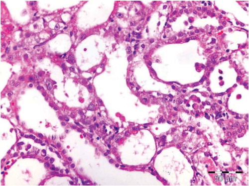 Figure 6. Cisplatin group tubular injury evidenced with apoptotic epithelial cells with shedding into lumen.