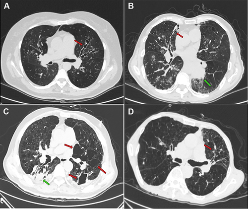 Figure 3 HRCT scans of patients with ABPA.