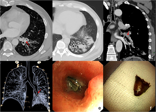Figure 3 A 47-year-old man with cough and expectoration for 8 years and definite history of pepper aspiration. Axial CT images show annular (red arrow) high density in the antero-medial basal segment bronchus of the left lower lobe (a) and bronchiectasis and consolidation (b). Coronal enhanced CT image (c) shows thickened bronchial wall adjacent to U-shaped high density foreign body and bronchial artery dilatation (arrows). Volume rendering image (d) shows occlusion of the bronchus with foreign body (arrow) and distal extensive bronchiectasis. Bronchoscopy examination shows purulent secretion mixed with red foreign body (e) in the opening of the bronchus. Finally, the foreign body is revealed as pepper shell (f).