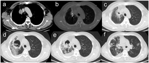 Figure 1. (a) A contrast-enhanced CT scan showing a single neoplasm, 3.5 × 2.4 cm, adjacent to mediastinal pleural in the right upper lobe before MWA. (b) MWA was performed at a power of 70 W for an accumulated total time of 11 min. (c) A follow-up CT scan at 24 hours after MWA showing a GGO-like reaction band around the lesion that almost surrounded the entire tumor. (d) At 28 days after MWA, the ablation zone was replaced by a large uneven thick-walled cavity containing a mass of irregular consolidation surrounded by patchy infiltration. (e) A chest CT scan at 6 weeks after MWA showing shrinkage of the cavity, incrassation of the wall, and aggravated infiltration. (f) A chest CT scan at 6 weeks after MWA also showing multiple patchy infiltrations and nodules scattered in both lung fields.