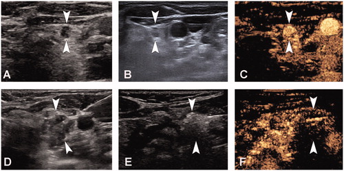 Figure 1. A 47-year-old woman who had undergone a total thyroidectomy 2 years ago for papillary thyroid cancer underwent microwave ablation (MWA) of cervical metastatic lymph nodes (LN). A, Pre-MWA, B-mode ultrasonography (US) showed hypoechoic LN (arrow); B, Fine-needle aspiration biopsy (FNAB) process of the LN (arrow); C, Pre-MWA, the contrast-enhanced US (CEUS) showed uneven and highly enhanced patterns (arrow); D, Spacer fluid (arrow) was injected to surround the LN; E, Hyperechoic (arrow) pattern in the LN during MWA; F, Post-MWA, the CEUS showed no enhancement (arrow) in LN.