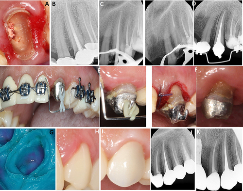 Figure 4 Preoperative intraoral view (A) and periapical view (B). During RCT, post space cementation (C and D), orthodontic extrusions (E), crown lengthening (F), prosthetic phase; final impression (G), provisional restoration (H), postoperative final prostheses (I), periapical X-ray (J), 6 months follow-up (K).