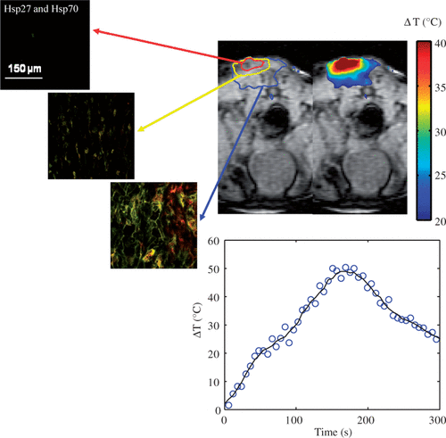 Figure 4. Hsp27 and Hsp70 expression dual stained image for three distinct tumour depths (top left) measured 16 h following laser irradiation in combination with nanoshells and corresponding MRTI measured mean maximum temperature increase for five mice (top right). Average change in temperature versus time at the tumour surface (bottom centre).