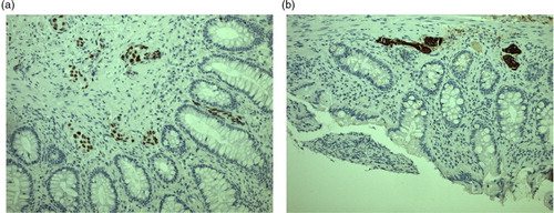 Fig. 1 Immunohistochemical staining of histological biopsy from rectal mass: an adenocarcinoma positive for TTF-1 (A) and CK7 (B).