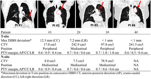 Figure 1. Primary tumor position of the four patients, for which the suggested method was tested (top row images) and summary of lesion and PTV characteristics (below). PTV margins were population based [Citation10], however, individually modified for patient #1 due to large tumor deviation between DIBHs.