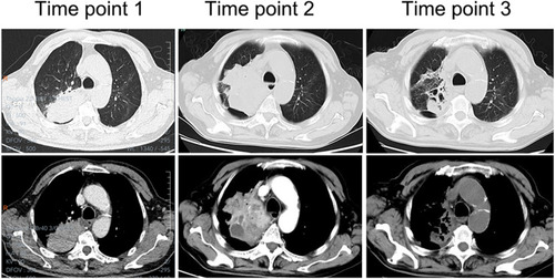 Figure 2 Lung CT manifestation of case 4. Time point 1: At the first visit, a mass lung consolidation shadow was visible in the right upper lobe. Time point 2: At 8 months of onset, a notably enlarged mass is visible, with liquefaction necrosis in the middle of the lesion. Time point 3: After effective treatment for 3 months, the lesion was significantly smaller with residual cavities and fibrous lesions.