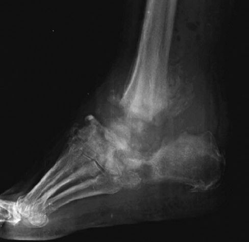 Figure 1. A case of severe CN with talar collapse.