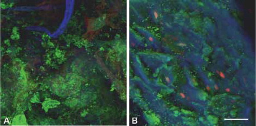 Figure 1. CLSM images of biofilm on soft tissue from patient 1. Overlay projection (includes all the slices in an image stack) of the biofilm at the center of the ulcer base (A) and at the edge of the ulcer base (B). Bar represents 75 µm. CLSM examination revealed the presence of bacteria ranging from single cells to large aggregates of grape-like clusters (panel A). The bacteria in these clusters were viable, as they appeared fluorescent green after LIVE/DEAD Baclight viability stain. Calcofluor white (blue) stained the EPS excreted by the bacteria (panel B). Host nuclei and fibrous material stained red with propidium iodide (panels A and B).