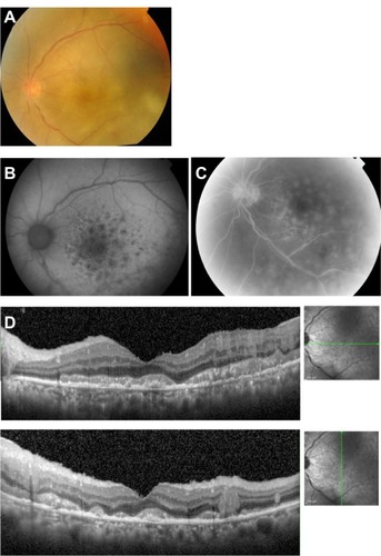 Figure 3 Case 3. Fundus images of the left eye in a 67-year-old man with primary intraocular lymphoma after vitrectomy.