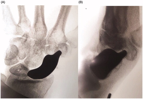 Figure 4. (A,B) In the perioperative radiography, the prosthesis position was verified as well as the position of the distal stem.