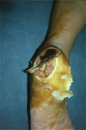 Figure 2. A 72-year-old male presented with a large diabetic foot ulcer over the left heel.