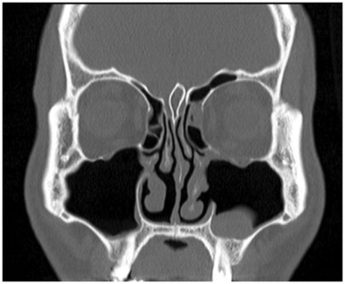 Figure 5. Postoperative computed tomography. The fracture of the inferior orbital wall and the dislocation of inferior rectus muscle were repaired.