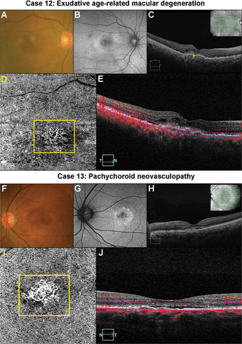 Figure 7. Two cases of likely choroidal macular neovascularisation detected with OCT-A imaging. (Case 12) a 78-year-old male with visual acuities of 6/95–2 right eye and 6.9/5 + 2 left eye referred for a macular assessment. His referring optometrist noted a recent drop in his right eye’s vision from 6/12 to 6/120. (A) The right eye’s colour fundus photograph shows large drusen at the macula. (B) Fundus autofluorescence imaging showed speckled central hypo-autofluorescence. (C) Structural OCT imaging showed subretinal fluid, intraretinal cystic spaces and subretinal hyperreflective material (yellow asterisk) at the fovea. (D) A neovascular network (yellow box) is noted on the 6 × 6 mm ORCC OCT-A image. (E) The reference lines on the central OCT b-scan from the OCT-A image cube is depicted by the pink dashed lines. (Case 13) a 56-year-old male with visual acuities 6/6 right eye and 6/19 (pinhole 6/15 + 1) left eye. There was generalised waviness across the central 10 degrees of the Amsler grid in the left eye. (F) Colour fundus photographs shows pigmentary abnormalities centrally in the left eye. (G) Fundus autofluorescence imaging shows central hypo-autofluorescence with surrounding hyper-autofluorescence at the left macula. (H) There was subretinal fluid overlying a flat irregular pigment epithelial detachment in the left eye on OCT imaging. The inset in the upper right-hand corner shows the OCT b-scan location. (I) A neovascular network (yellow box) is present on 3 × 3 mm macular OCT-A image of the ORCC slab. (J) OCT b-scan derived from the OCT-A image cube shows the slab reference points (pink lines).