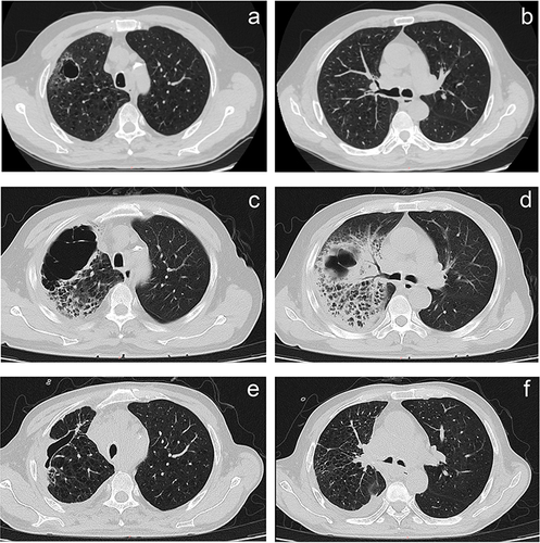 Figure 1 Chest CT imaging. (a and b) On September 20, 2022, the anterior subpleural cavity of the upper lobe of the right lung was observed, with a maximum cross-section of 21 mm×20 mm, and the shadow was exudated by ground glass. (c and d) September 24, 2022, The irregular cavity in the anterior segment of the upper lobe of the right lung was significantly enlarged, and the maximum section of the cavity was about 83 mm×54 mm. Flocculent tissue was observed in the cavity, and large flake consolidation and exudation shadows were observed around and in the posterior segment of the upper lobe of the right lung against the background of emphysema. (e and f) On April 21, 2023, the cavity in the upper lobe of the right lung contracted and decreased, and the consolidation exudation was roughly absorbed.