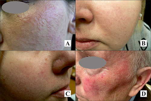 Figure 1 Clinical presentation of various clinical type of rosacea: (A) papules, (B) papules and telangiectases, (C) erythema and telangiectases, (D) erythema, telangiectases, and papules. Property of the author.