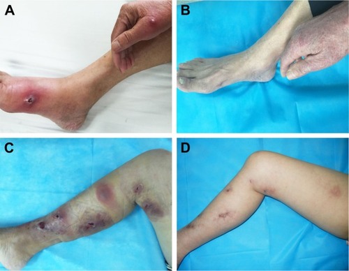 Figure 1 Course of treatment.Notes: Clinical features of case 2: (A) at the first visit and (B) 12 months later. Clinical features of case 3: (C) at the 11th day of treatment and (D) 12 months later.