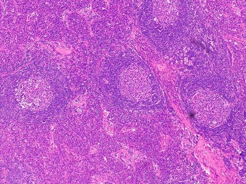 Figure 4 Typical pathological image of plasma cell (PC) subtype. The picture shows a patient with MCD who underwent pathological puncture of lymph nodes and was diagnosed as PC subtype of CD by H&E staining.