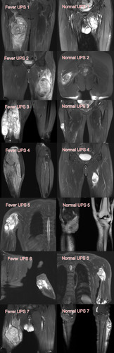 Figure 2 MRI findings of all seven patients with UPS with fever (Fever UPS) and seven randomly selected patients with UPS without neoplastic fever (Normal UPS). In patients with UPS with neoplastic fever, MRI shows necrosis inside the tumor body; all tumors span the muscular space, and extensive soft tissue edema around the tumor is noted. Most cases of UPS without neoplastic fever did not exhibit these features on MRI.