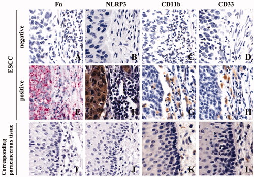 Figure 2. Fn infection, NLRP3 expression and MDSCs enrichment in ESCC tissues (×400). A/E/I: Fn infection was detected by RNAscope (16S rRNA); B/F/J: NLRP3 expression was detected by IHC; C/D/G/H/K/L: MDSCs infiltration (CD11b and CD33) was detected by IHC.