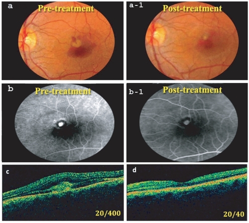 Figure 2 (a) Pretreatment fundus photo showing juxtafoveal CNV with subretinal hemorrhage occupying about 50% of the lesion (BCVA = 20/400). (a-1) Post-treatment fundus photo at 6 months. Note regression of the membrane and absorption of most subretinal blood (BCVA = 20/40). (b) Pretreatment FLA, showing active CNV. (b-1) Post-treatment FLA showing CNV staining with no leakage. (c) Pretreatment OCT showing the CNV with fluid in the subretinal space (CRT = 800 μm). (d) OCT 6 months post-treatment with almost normal foveal configuration (CRT = 280 μm).