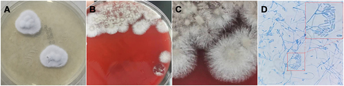 Figure 2 Morphological results of the pus culture. (A) Sabouraud dextrose agar medium showed the white-greyish, cottonlike colonies. (B and C) The thin, septate branching hyphae were observed on Columbia blood agar plate. (D) The lacto-phenol cotton blue staining showed the thick mycelium, along with the production of terminal oval conidia and a brush of cylindrical conidia (400× magnification).