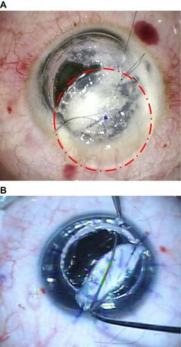 Figure 2 (A) Stable anterior chamber filled with air after suturing the previously excised stromal tissue the circle delineate the sutured whole cap of the previously excised stromal tissue. (B) Stromal dissection using Barraquer spatula while the anterior chamber is filled with air (intraoperative picture).