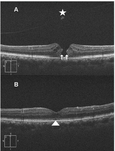 Figure 2 (A) High-definition 5-line raster OCT image of the left eye of a 75-year-old female with idiopathic FTMH. Note the fully detached posterior hyaloid and the hole operculum (star). The hole shows thickened edges with cystic spaces, and upward lift of the ELM and IS/OS junction layers (2 white arrows). MLD of the hole was 200µ. Preoperative BCVA was 6/36. (B) Postoperative OCT image of the same patient taken at 3-month follow-up visit. Note U-type hole closure with restoration of ELM and IS/OS layers. Note the residual defect in the IS/OS junction layer (white arrow head). Postoperative BCVA improved to 6/9.