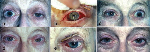Figure 5. Seesaw relationship of upper lids – over correction of ptosis in patient aged 68. (a) LUL ptosis after intracapsular cataract extraction and iris-clip IOL (1976); (b) pupil dilatation after retrobulbar LA injection would have dislocated the IOL to prevent that subconj injection of pilocarpine 0.1 ml, 4%, given 5 min before retrobulbar LA with effective miosis; (c) 8 mm MT flap resection resulted in over correction; (d) attempted correction with a rectangular preserved fascia lata graft and resulting medial half slanting lid margin; (e) further corrective surgery with 4 mm levator complex resection confined only to medial half at one week; and (f) final satisfactory result.With acknowledgements to PostScript Media Pvt Ltd.