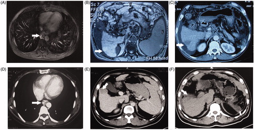 Figure 1. Typical images showing an HCC nodule treated with MWA or HR and CSPH treated with PCDV. (A) Preoperative contrast enhanced venous phase MR image (T1W1) of EV (arrow). (B) Pre-operative T1 weighted image (T1WI) of an HCC nodule (arrow). (C) Post-operative contrast enhanced arterial phase CT image of the same patient who was treated with MWA and PCDV and no enhancement was observed in the ablation zone (arrow). (D) Pre-operative contrast enhanced venous phase CT image of EV (arrow). (E) Pre-operative contrast enhanced venous phase CT image of an HCC nodule (arrow). (F) Post-operative plain CT image of the operative region of the same patient who was treated with HR and PCDV (arrow).