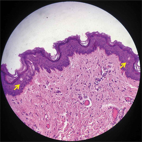 Figure 4. Histology from specimen No.4 demonstrating intra-epidermal LIOB (Hematoxylin and eosin (H&E), 200X).