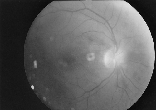 FIGURE 1 The right eye fundus exhibiting a swollen optic disc with blurred margins.