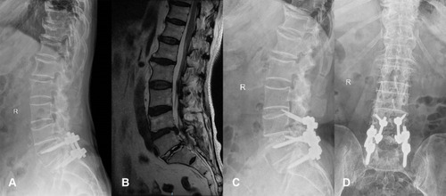 Figure 4 Case 3. A 58-year-old female had undergone prior L5/S1 fusion. She had ASD of L4/5 at the current presentation. (A) Preoperative X-ray showed original fixation of L5/S1. (B) Preoperative MRI revealed a disc herniated into the spinal canal. (C and D) X-ray after the surgery showed good positioning of the CBT screws.