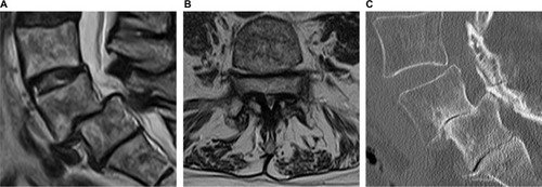 Figure 4 Sagittal (A) and axial (B) MRI and sagittal CT (C) scans show grade I–II degenerative spondylolisthesis at L4–L5, total collapse of the disc, and severe spinal stenosis.