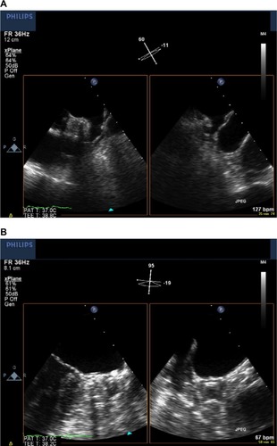 Figure 2 X-plane two-dimensional transesophageal echocardiographic images of the left atrium before (A) and 45 days after (B) successful occlusion of the left atrial appendage using the Watchman device.