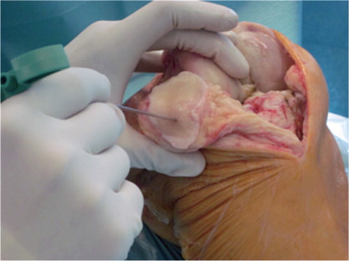 Figure 1. Obtaining the biopsy of the patella.