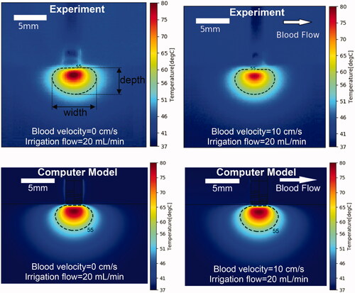 Figure 4. Temperature profiles of representative perpendicular catheter orientation of experiments (top) and computer simulations (bottom). Results are shown at the end of the 60 s ablation at constant power of 5 W, for an irrigation flow rate of 20 ml/min and blood velocity of either 0 or 10 cm/s. Direction of blood flow is indicated in the upper right image. 55 °C isotherm is marked as estimate of thermal lesion size, with lesion width and depth indicated in the upper left figure.