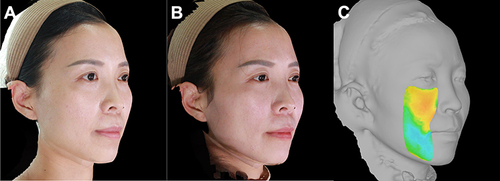 Figure 11 A 36-year-old female whose main complaint was mid-facial ptosis and a flat anterior mid-cheek. The two-step fat repositioning technique was performed. (A) Preoperative 3D photograph; (B) 6 months post-operative photograph; (C) 3-dimensional color map of the mid-cheek and jowl regions representing volume change at 6 months.