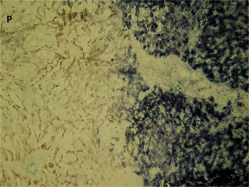 Figure 9. Parenchyma (magnification ×10) from the edge of the white zone sampled as a frozen section, stained for NADH. P indicates the site of antenna insertion. The sudden change from viable to non-viable tissue on NADH staining appears to correlate with the border between the white zone and the surrounding red zone on macroscopic section. Identifying this transition from treated to untreated tissue on routine H&E analysis was more difficult, with a more subtle change in cellular appearance.
