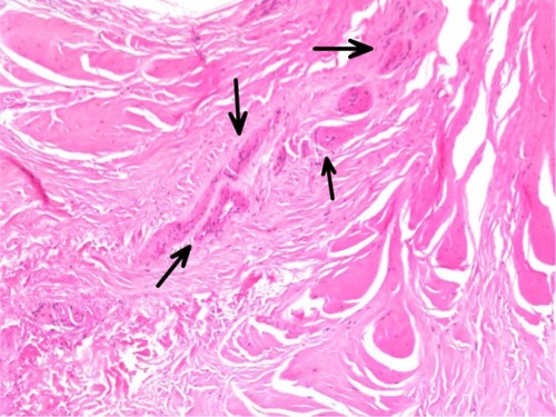 Figure 5 Vascular proliferation with clusters of capillaries visualized (arrows).
